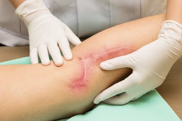 scar prepared for PRP treatment